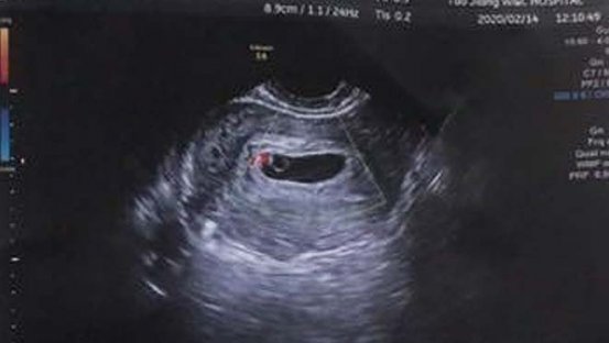 美国试管婴儿促排卵流程