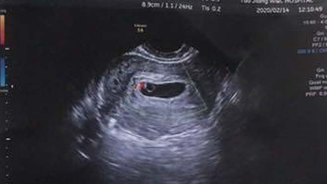 美国试管婴儿促排卵流程-1